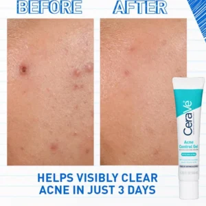 Acne Control Gel Acne Control Gel - Image 3