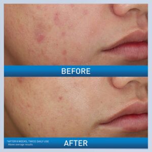 Acne Foaming Cream Wash - Image 3