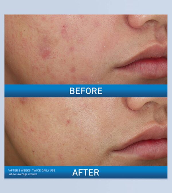 Acne Foaming Cream Wash 2