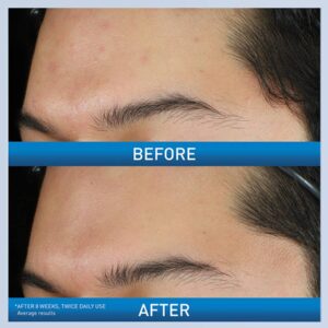 Acne Foaming Cream Wash - Image 4