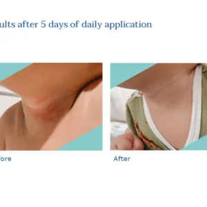 Stelatopia Intense Eczema Relief Stelatopia Intense Eczema Relief - Image 3