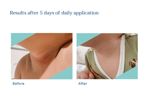 Stelatopia Intense Eczema Relief Stelatopia Intense Eczema Relief 2